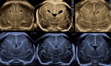 Fetal Brain Imaging 