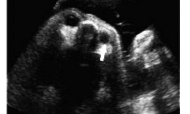 Oculo-auriculo-vertebral spectrum.png