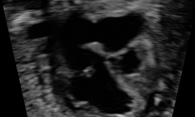 Pulmonary atresia with intact ventricular septum (PA-IVS).png
