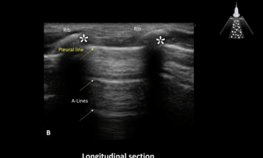 How to lung ultrasound.png