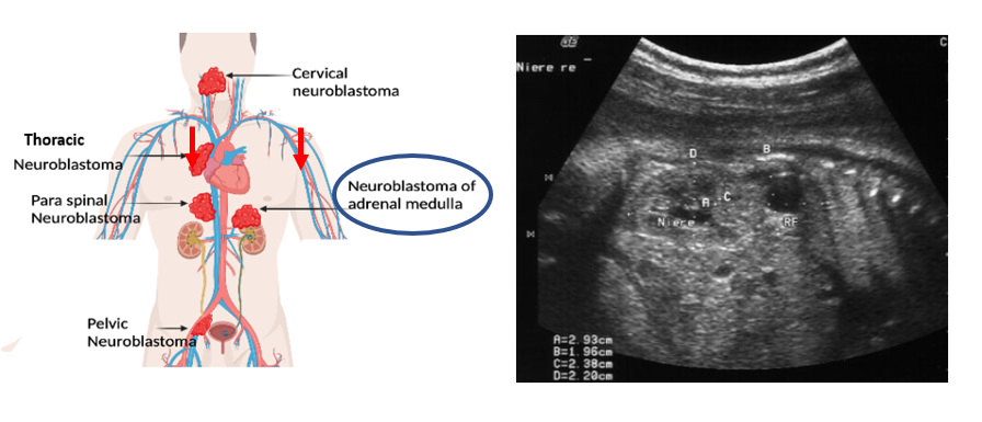 illustration of body with main sites around the body where neuroblastoma can occur next to ultrasound scan image