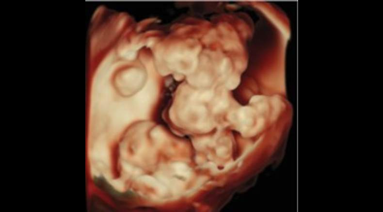 Tumor 1.1.png