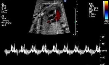 fetal tachycardia.jpg