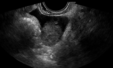 ovarian torsion and MOE.PNG