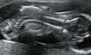 Cloacal Exstrophy main picture.png
