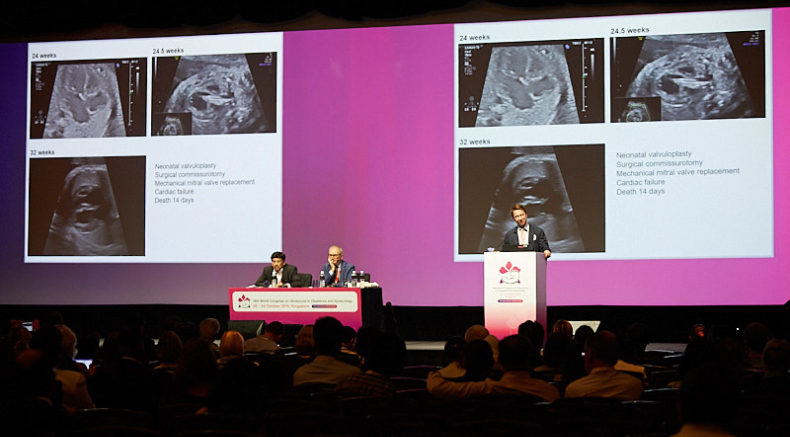 CONGRESS SESSION ISUOG2018 good slides up.jpg