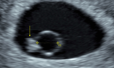 Normal Early pregnancy.png