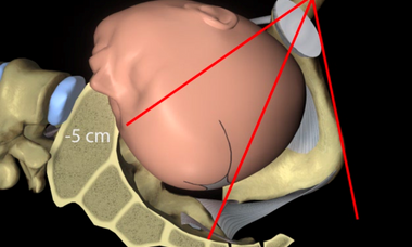 Fetal head station.png