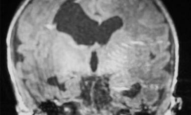ventriculomegaly_MRI.jpg