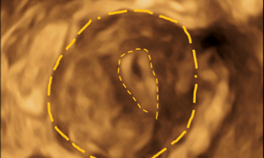 Hemi-uterus.png