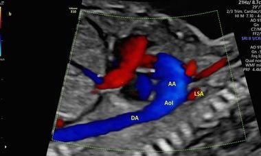 Aortic Isthmus Doppler.jpg