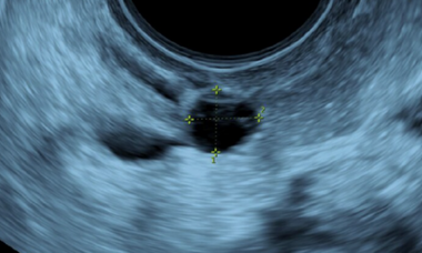 Imaging-in-gyne-disease-ultrasound-cyst.png