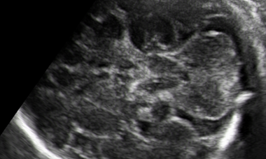 Rhombencephalosynapsis.png