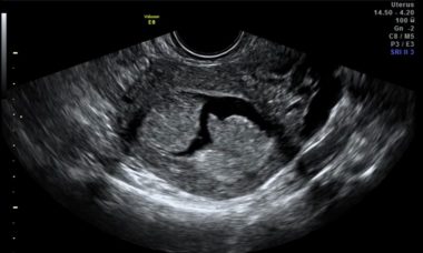 Hyperplasia Main Image.jpg