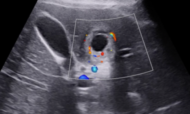 Hepatic ectopic from VISUOG.png 2