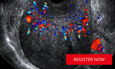 Uterine pathology scan image from VISUOG