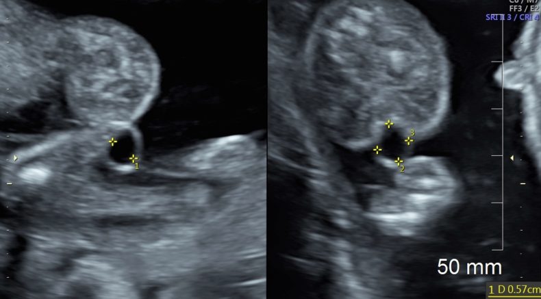 megaurethra twin B.jpg