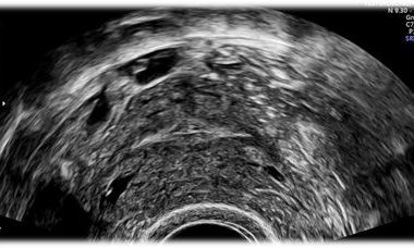 Sonosalpingography.jpg