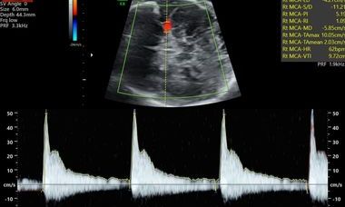 Bradycardia.jpg