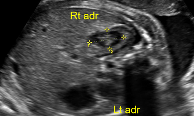 Adrenal Hemorrhage.png