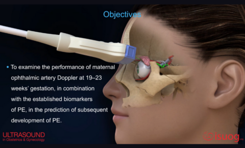 UOG video abstract: Ophthalmic artery Doppler pre-eclampsia