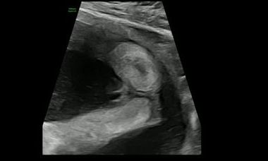 fetal g hypospadias.jpg