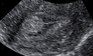 Endometrial Polyps Main Image.jpg