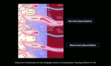 Pre-eclampsia - Placenta