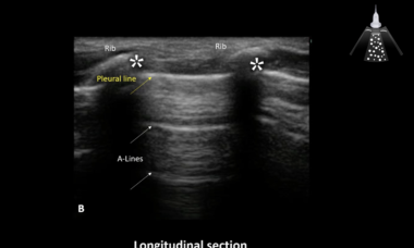 How to lung ultrasound pregnancy covid.png