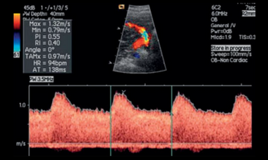 normal-artery-doppler-2nd-trimester.png