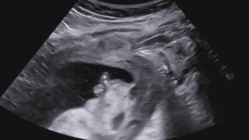 heterotopic-pregnancy