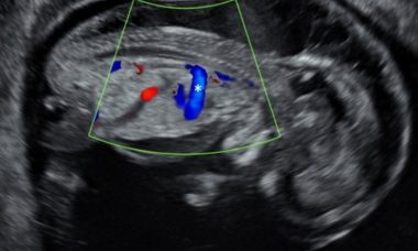 Pulmonary valve syndrome and trisomy 18.jpg 1st tri