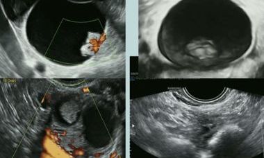 Advanced ultrasound guided interventions in gynecology webinar image.jpg