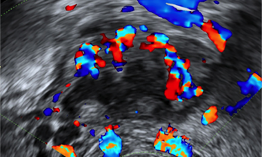 Pelvic-pain-and-endometriosis.png 6