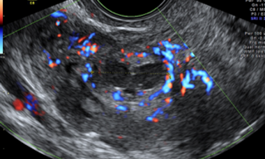 uterine fibroids.png