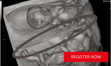 3D twin pregnancy ultrasound image in black and white