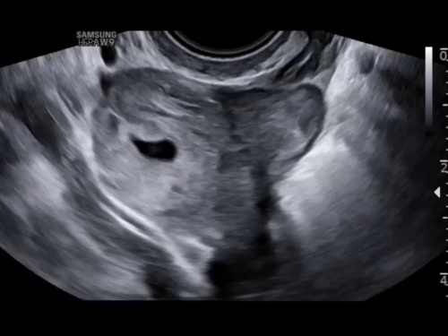 Ultrasound Guided Tips - Yolk sac and ring of fire ...mostly ectopic  pregnancy | Facebook