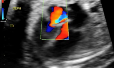 Pulmonic stenosis.png