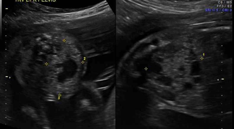 Ectopic Kidneys 1.png 3