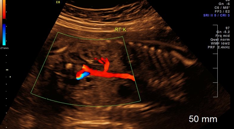 Ectopic Kidneys 3.png