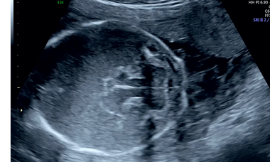 Hydranencephaly.png
