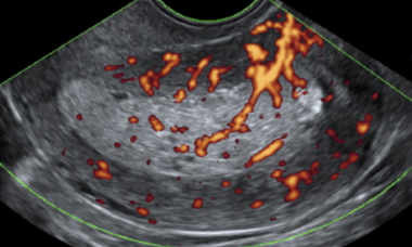 Endometrial pathology 2.png