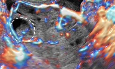 tumor 3.jpg