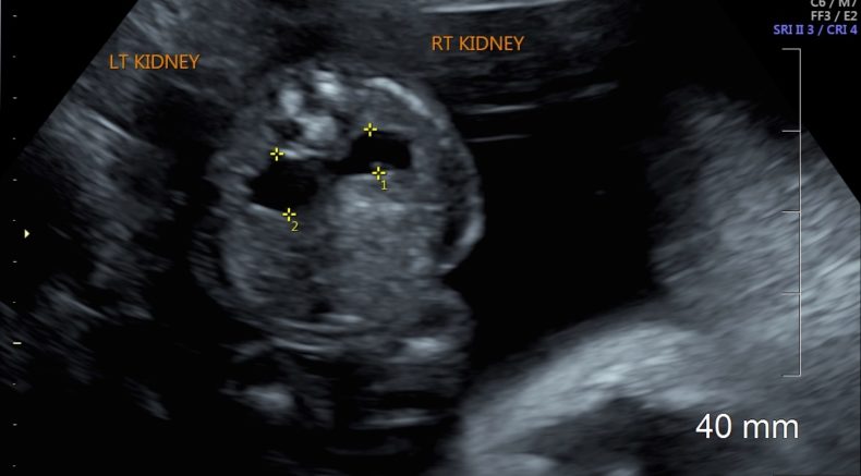 hydronephrosis.jpg