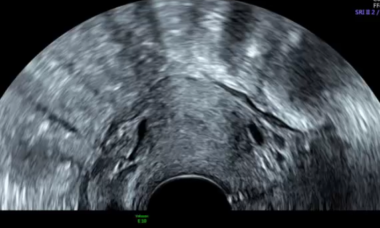 Septate Uterus Image.png