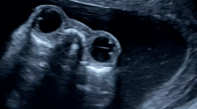 Exophtalmos_anencephaly.png
