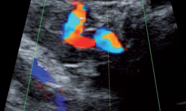 Uterine artery Doppler.jpeg 1