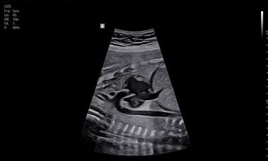 Z20 Fetal Heart.JPG 1