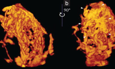 intraplacental hypervascularity uog14952.jpeg 1