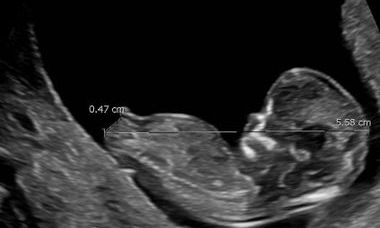 Fetal genitalia first trimester image